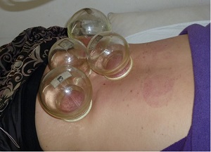 Cupping on the Back